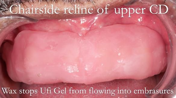 Finlay's Newsletter 62 provision of extractions and metal based complete dentures for Rafique