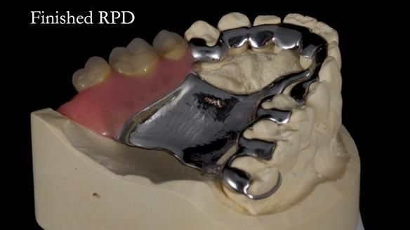 Finlay's Newsletter 64 case study - provision of a Kennedy class 2 metal based Scandinavian RPD for Ian
