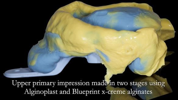 Newsletter 52 Managing Jo’s failing dentition with extractions and Mk 1/Mk 2 complete upper dentures and lower partial dentures FULL PROTOCOL