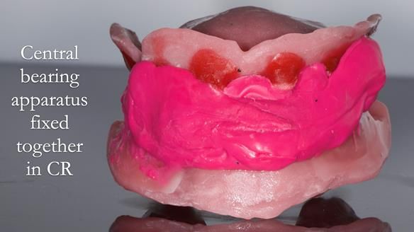 Managing poor implant positioning with complete dentures and Locator attachments - full protocol Newsletter 41