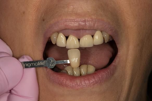 Figure 15 Shade taking for immediate denture