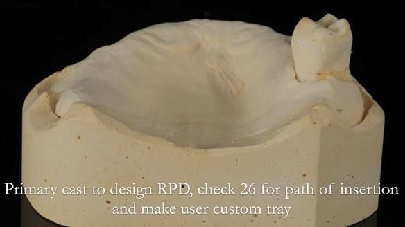 Finlay's Newsletter 58 Gasket upper partial denture for Zoe