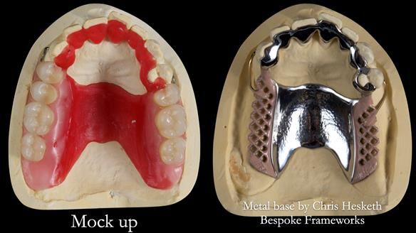 Newsletter 56 showing the making and fitting of a bilateral free end saddle upper removable partial denture (RPD) for patient with pemphigus