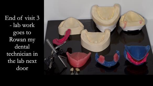 Newsletter 80 - Gordon’s dentures: the one case in 1,000 where my technique failed