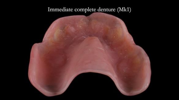 Newsletter 77: Jeremy’s case – immediate complete upper denture