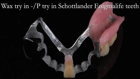 Newsletter 54 case presentation upper complete denture and lower Scandinavian designed hygienic partial denture for David