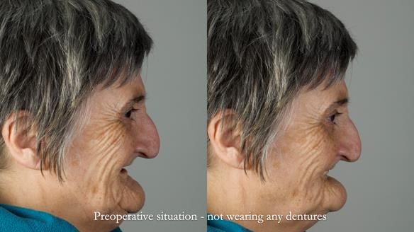 Newsletter 83: Sheila’s Complete Denture Success