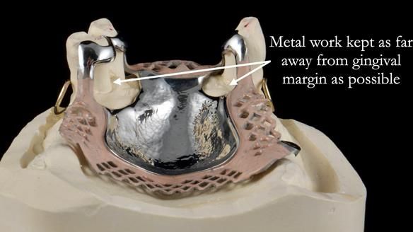 Finlay's Newsletter 59 Ultra hard partial dentures made for Gill