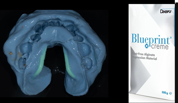 Figure 13 Lower primary impression with Dentsply Blueprint