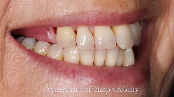 Newsletter 56 showing the making and fitting of a bilateral free end saddle upper removable partial denture (RPD) for patient with pemphigus