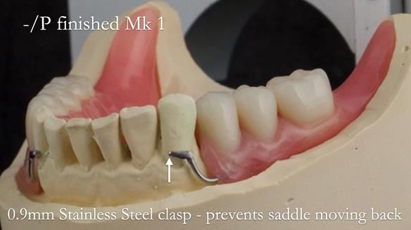Newsletter 52 Managing Jo’s failing dentition with extractions and Mk 1/Mk 2 complete upper dentures and lower partial dentures FULL PROTOCOL