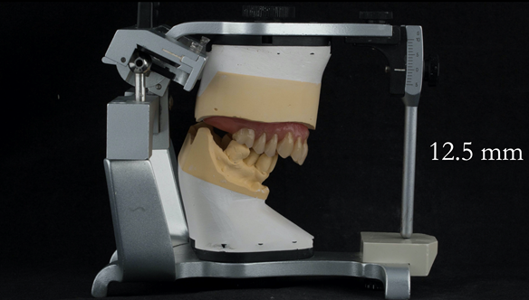 Figure 96 Mk 2 definitive denture finished - 12.5 mm overjet