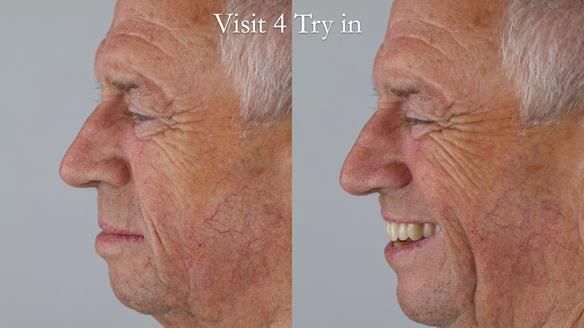 Newsletter 54 case presentation upper complete denture and lower Scandinavian designed hygienic partial denture for David