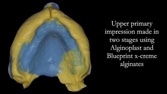 Newsletter 54 case presentation upper complete denture and lower Scandinavian designed hygienic partial denture for David