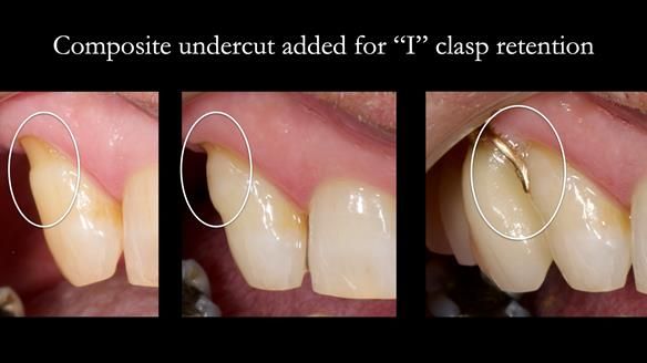 Newsletter 86 Peter the Architect — precision removable partial dentures case study