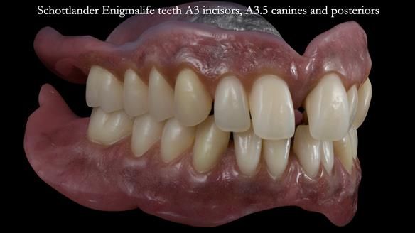 Newsletter 53 showing the making and fitting of ultra life-like dentures for Valena