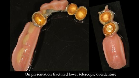 Newsletter 76: Jackie’s case – Telescopic overdenture & precision RPD (the tricky truth!)