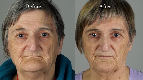 Newsletter 83: Sheila’s Complete Denture Success