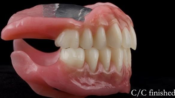 Managing poor implant positioning with complete dentures and Locator attachments - full protocol Newsletter 41