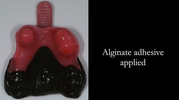 Finlay's Newsletter 59 Ultra hard partial dentures made for Gill