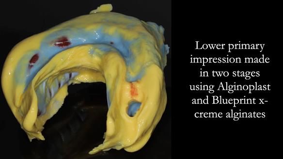 Finlay's Newsletter 59 Ultra hard partial dentures made for Gill