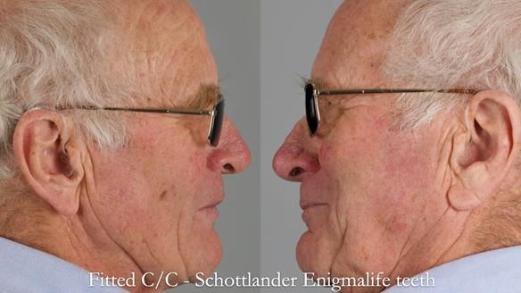 Complete denture Class II div 2 deep overbite Newsletter 39