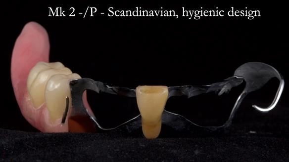 Newsletter 54 case presentation upper complete denture and lower Scandinavian designed hygienic partial denture for David