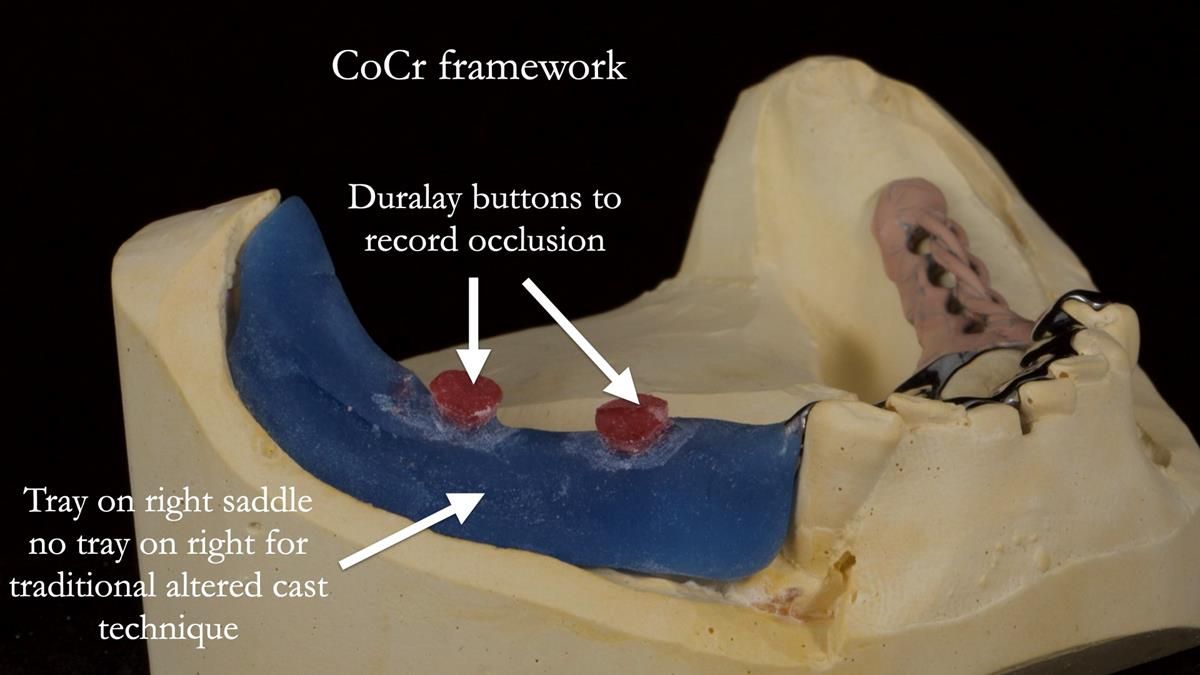 Newsletter 87 – Father Peter: A Partial Denture that needed Minor Miracle