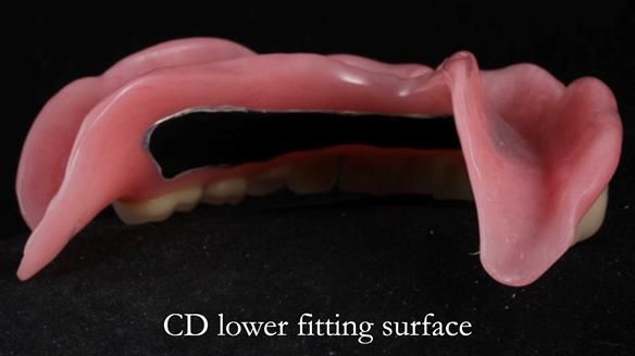 Finlay's Newsletter 62 provision of extractions and metal based complete dentures for Rafique