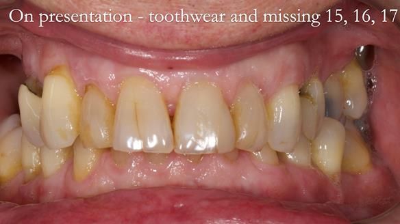 Finlay's Newsletter 64 case study - provision of a Kennedy class 2 metal based Scandinavian RPD for Ian