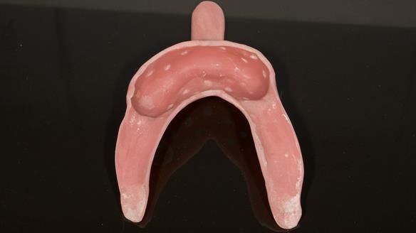Figure 71 Mandibular special tray (close fitting on saddles spaced over the teeth with perforations) for Mk 2 denture