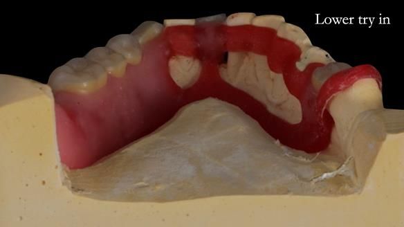 Newsletter 55 Provision of metal based partial dentures for Zephyrine with a repaired cleft lip and palate