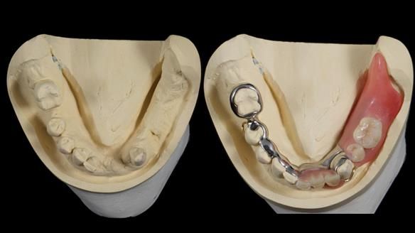 Newsletter 86 Peter the Architect — precision removable partial dentures case study