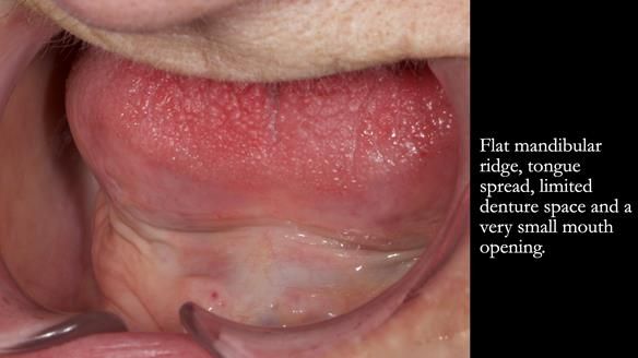 Newsletter 83: Sheila’s Complete Denture Success