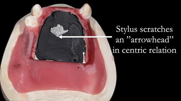 Finlay's Newsletter 59 Ultra hard partial dentures made for Gill