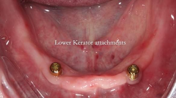 Newsletter 57 showcases the making and fitting process of implant-supported complete dentures for Alisdair