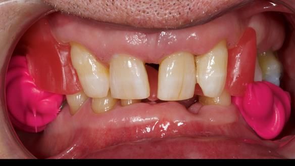 Newsletter 86 Peter the Architect — precision removable partial dentures case study