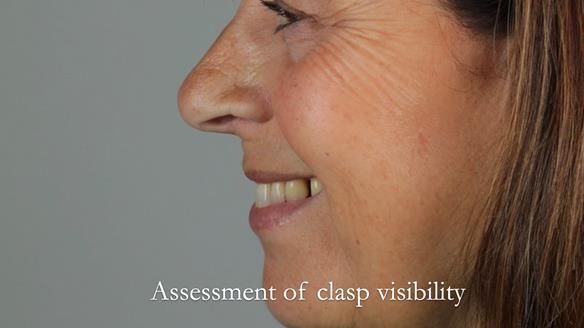 Newsletter 56 showing the making and fitting of a bilateral free end saddle upper removable partial denture (RPD) for patient with pemphigus