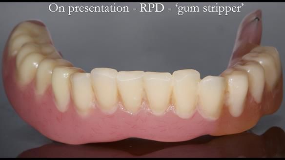 Finlay's Newsletter 59 Ultra hard partial dentures made for Gill