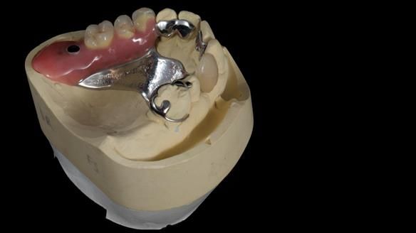 Newsletter 86 Peter the Architect — precision removable partial dentures case study