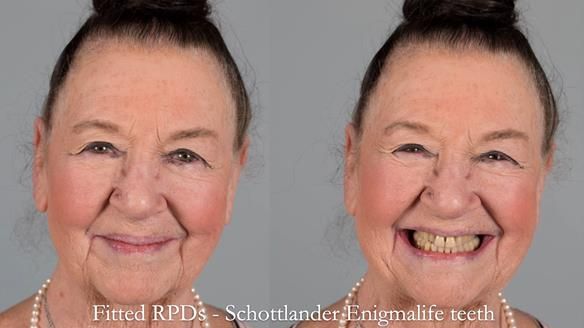 Finlay's Case Study Newsletter 40 - Immediate Mk 1 RPD to Definitive Mk 2 RPD - full protocol