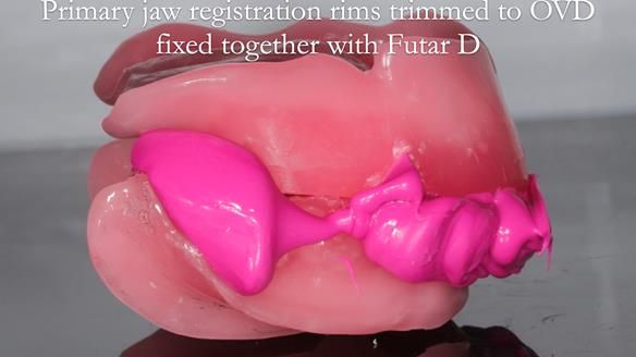 Newsletter 65 Marisa Provision of Complete Dentures on badly placed implants