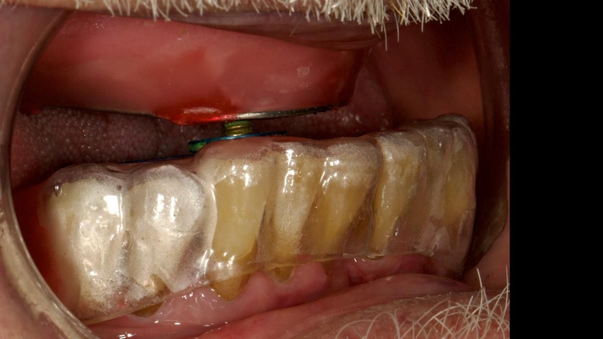 Newsletter 87 – Father Peter: A Partial Denture that needed Minor Miracle