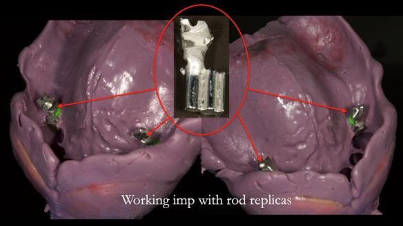 Newsletter 76: Jackie’s case – Telescopic overdenture & precision RPD (the tricky truth!)