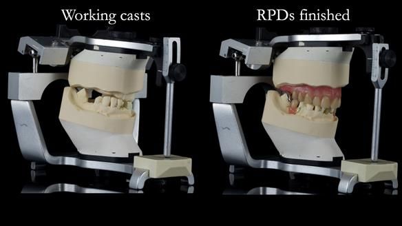 Newsletter 55 Provision of metal based partial dentures for Zephyrine with a repaired cleft lip and palate