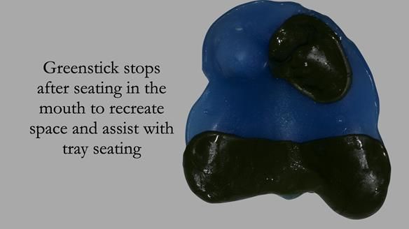 Newsletter 55 Provision of metal based partial dentures for Zephyrine with a repaired cleft lip and palate