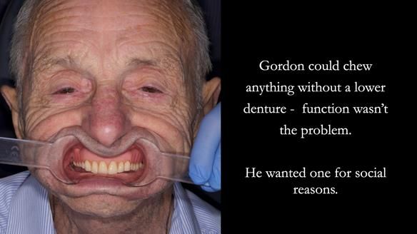Newsletter 80 - Gordon’s dentures: the one case in 1,000 where my technique failed