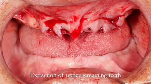 Finlay's Newsletter 62 provision of extractions and metal based complete dentures for Rafique