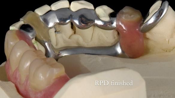 Newsletter 55 Provision of metal based partial dentures for Zephyrine with a repaired cleft lip and palate