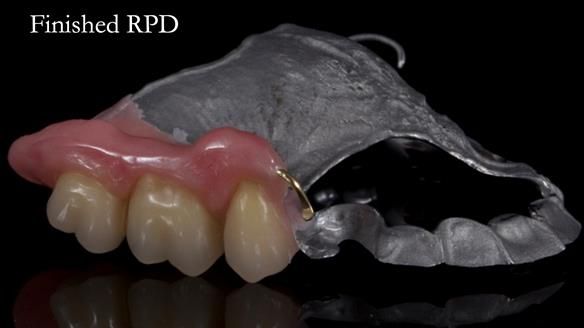 Finlay's Newsletter 64 case study - provision of a Kennedy class 2 metal based Scandinavian RPD for Ian